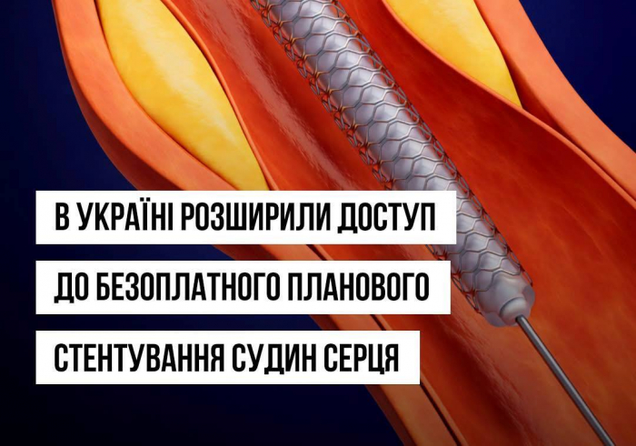 В Україні розширили доступ до безоплатного планового стентування судин серця